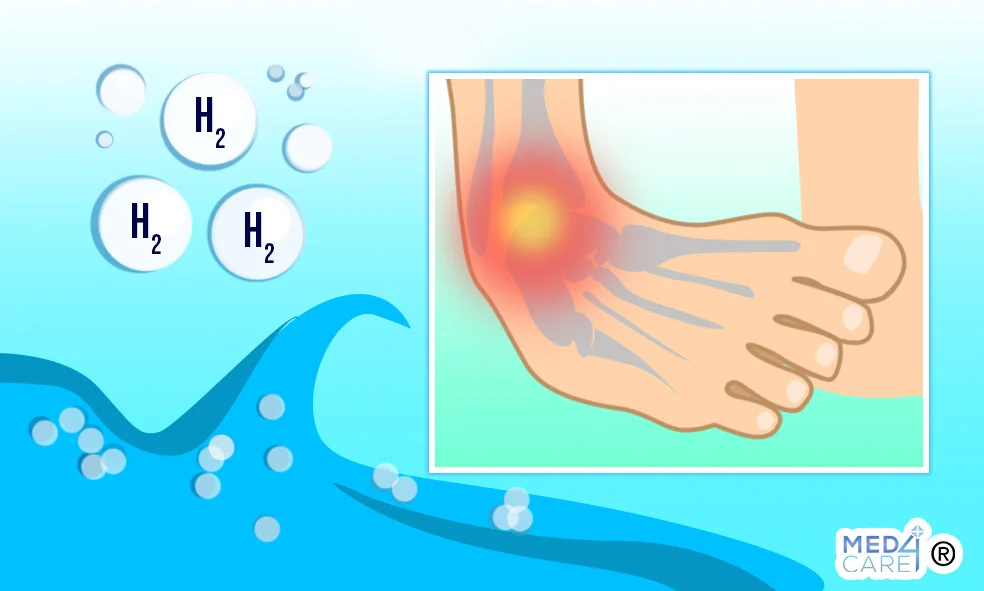 Trattare la slogatura alla caviglia con acqua idrogenata