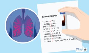 Scopri di più sull'articolo Polmonite da aspirazione: nuovi marker per la diagnosi di ab ingestis?