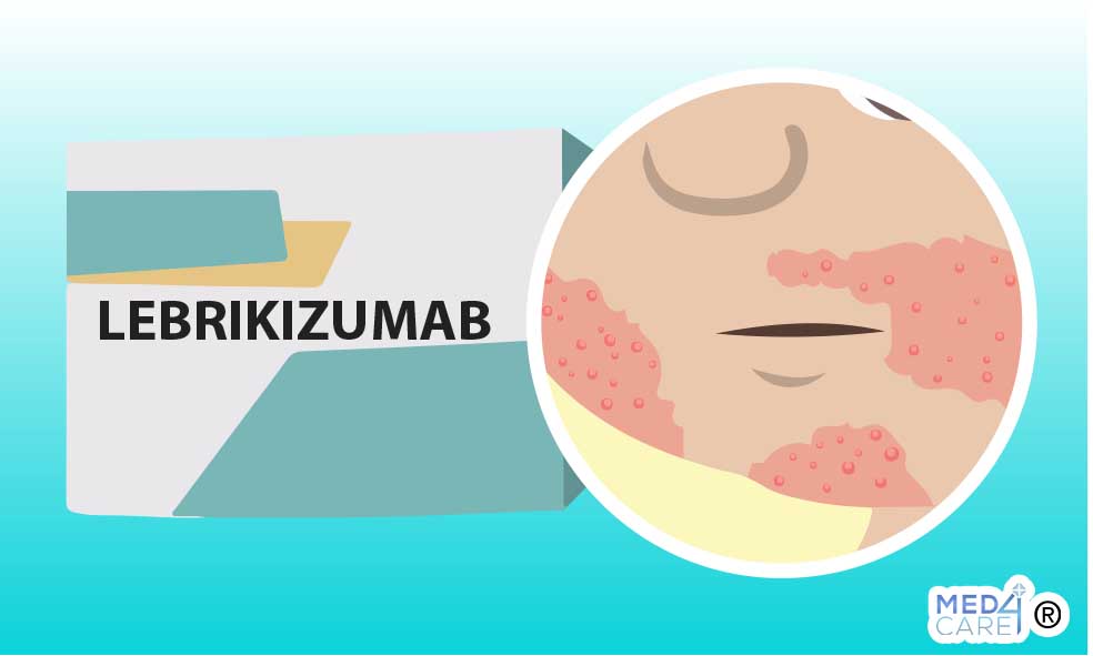 Lebrikizumab e dermatite atopica, dermatite, anticorpi monoclonali, Lebrikizumab