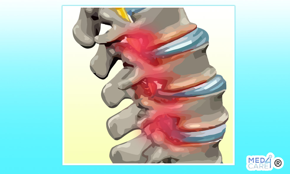 stenosi vertebrale sintomi, stenosi vertebrale