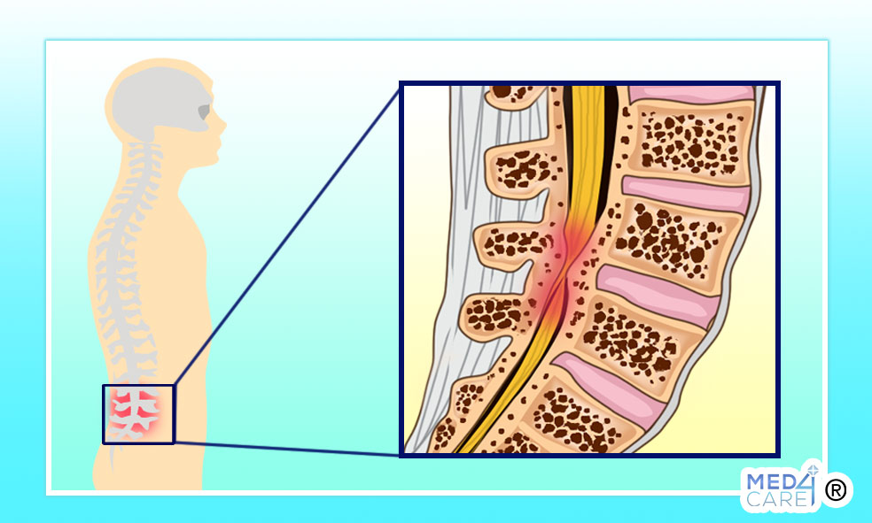 stenosi vertebrale trattamento, stenosi vertebrale