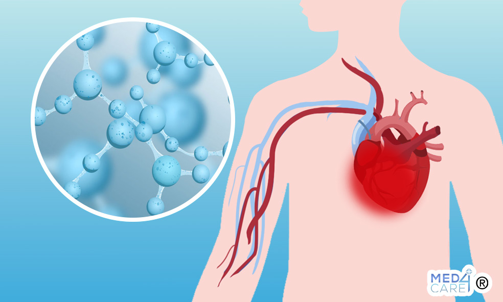 Infarto del miocardio e idrogeno molecolare, idrogeno molecolare, acqua idrogenata, infarto del miocardio, infarto