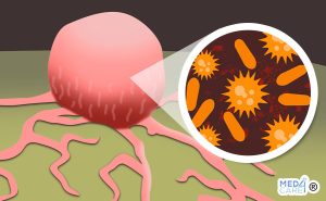 Scopri di più sull'articolo Le infezioni possono allenare le nostre cellule a combattere i tumori?