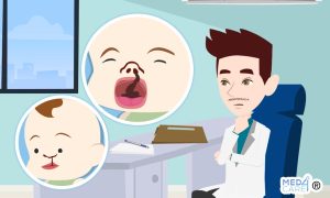 Scopri di più sull'articolo Quando è più utile correggere con l’intervento chirurgico il labbro leporino nei neonati?