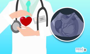 Scopri di più sull'articolo Come si può preservare al meglio la funzione del cuore in pazienti affetti da amiloidosi cardiaca?