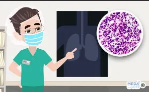 Scopri di più sull'articolo Terapie biologiche per la cura dei tumori non a piccole cellule del polmone: mutazione del gene EGFR