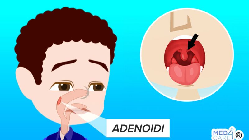 adenoidi, adenoidi ingrossate, adenoidite, ipertrofia adenoidea