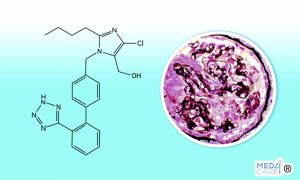 Scopri di più sull'articolo Glomerulosclerosi focale segmentaria e rischio di IRA: efficacia del trattamento con farmaci che bloccano il recettore dell’angiotensina II