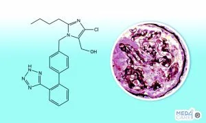 Scopri di più sull'articolo Glomerulosclerosi focale segmentaria e rischio di IRA: efficacia del trattamento con farmaci che bloccano il recettore dell’angiotensina II