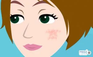 Scopri di più sull'articolo Dermatomiosite