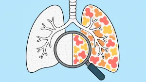 Due polmoni a confronto: uno con pattern ARDS classico uniforme e uno con pattern multipli frammentati da cause rare, con lente di ingrandimento sulle differenze diagnostiche