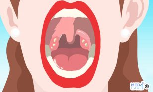 Placche in gola, infezioni della gola, otorinolaringoiatria, otorinolaringoiatra, sintomi di infezione