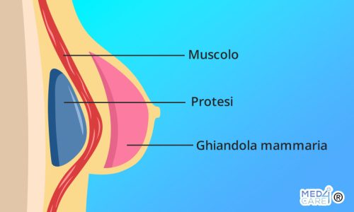 Mastoplastica additiva sottomuscolare, tecnica sottomuscolare, mastoplastica additiva